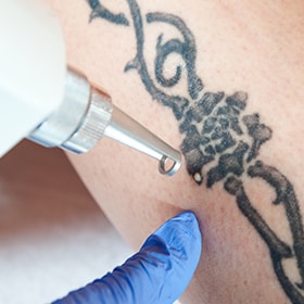 Effacer un tatouage par Laser pigmentaire Q-Switched à Poitiers