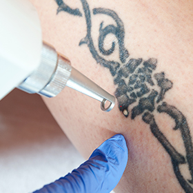Détatouage, éliminer un tatouage au laser Q-Switched à Poitiers
